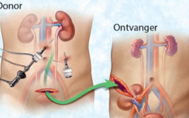 Screening patienten voor niertransplantaties gestart