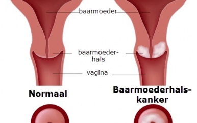 Taboe rond baarmoederhalskanker moet doorbroken worden