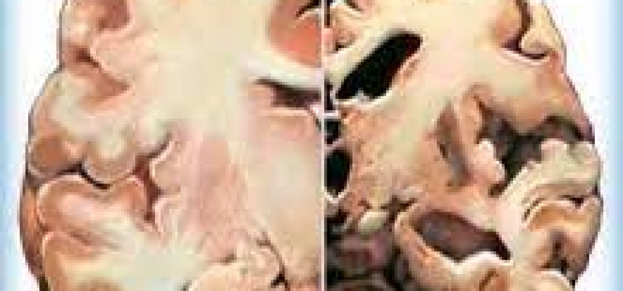 Nog te weinig bewustzijn over Alzheimer als hersenziekte