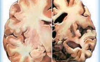 Nog te weinig bewustzijn over Alzheimer als hersenziekte