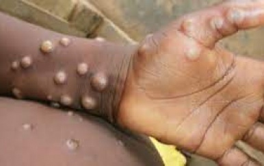 UNAIDS waarschuwt voor stigmatisering Apenpokken