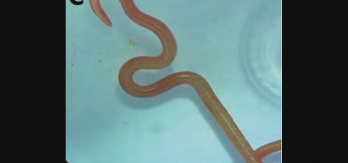 Chirurgen vinden levende worm van 8 centimeter in hersenen vrouw