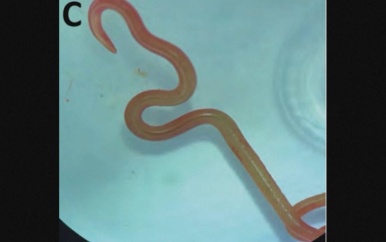 Chirurgen vinden levende worm van 8 centimeter in hersenen vrouw
