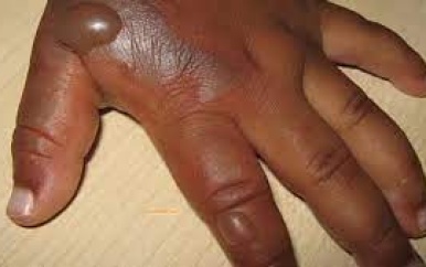 [UPDATEN] moeder die 8-jarige zoon brandwonden toebracht, vrijgelaten