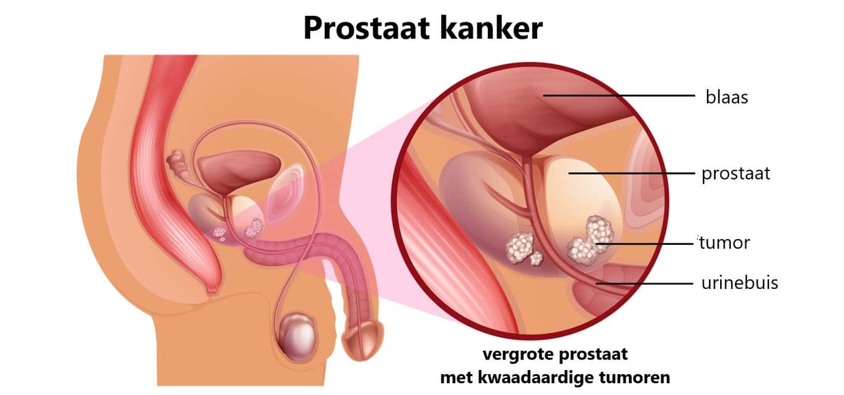 Jaarlijks 100 gevallen van protaat in Suriname
