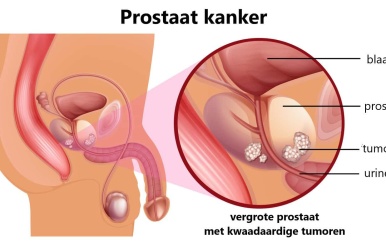 Jaarlijks 100 gevallen van protaat in Suriname