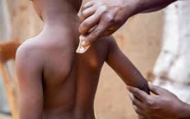 Unicef doet noodaanbesteding om mpox-vaccins veilig te stellen