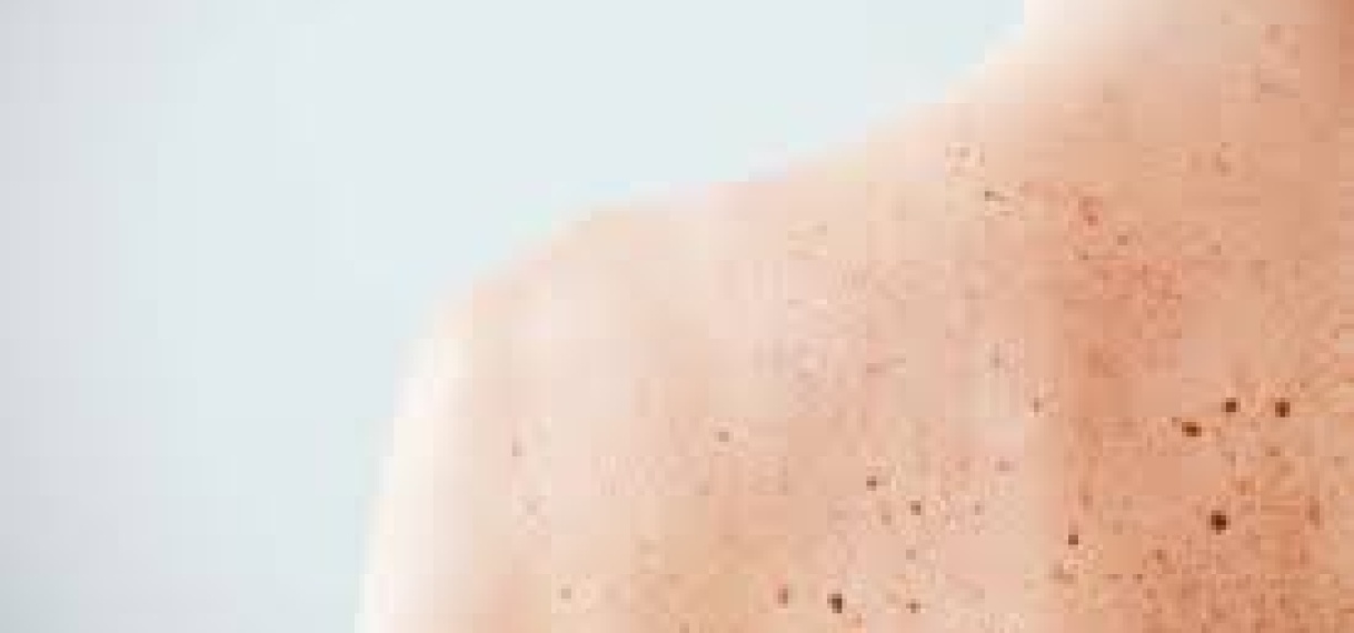 Deel inwoners Katwijk heeft tot 60 procent meer kans op melanoom door erfelijk gen