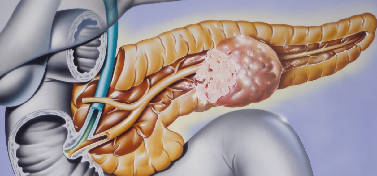 Eerste patiënt met alvleesklierkanker behandeld met nieuwe therapie
