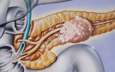 Eerste patiënt met alvleesklierkanker behandeld met nieuwe therapie