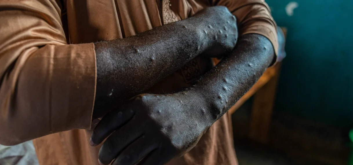 Nederlandse viroloog aangeklaagd om smokkel mpox-monsters in VS