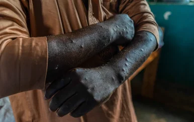 Nederlandse viroloog aangeklaagd om smokkel mpox-monsters in VS